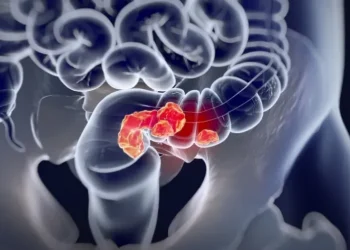 Ilustração médica realista mostrando tumor no intestino grosso, destacando câncer colorretal.