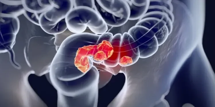 Ilustração médica realista mostrando tumor no intestino grosso, destacando câncer colorretal.