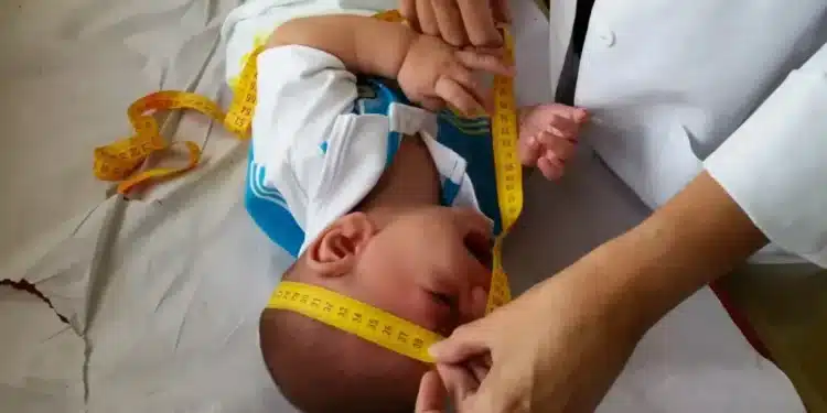 Imagem destacada Novo benefício do INSS ampara crianças com sequelas do Zika: veja valores e como solicitar