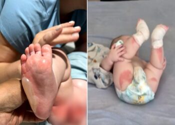 Bebê sofre queimaduras de segundo grau em 29% do corpo durante banho em berçário de Rio Verde