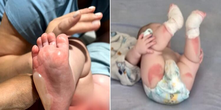 Bebê sofre queimaduras de segundo grau em 29% do corpo durante banho em berçário de Rio Verde
